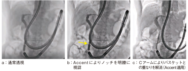 図4 症例1:総胆管結石症例(Accent適用+Cアーム) 図4 症例1:総胆管結石症例(Accent適用+Cアーム)