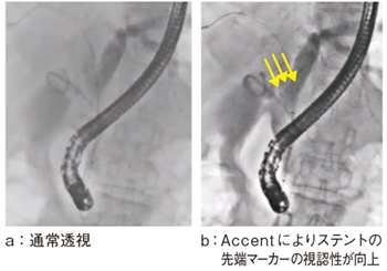図5 症例2:膵がん症例(Accent適用) 図5 症例2:膵がん症例(Accent適用)