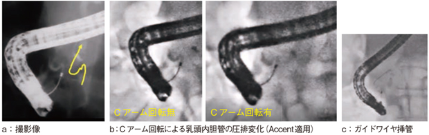 図6 症例3:膵鉤部がん症例(Accent適用+Cアーム) 図6 症例3:膵鉤部がん症例(Accent適用+Cアーム)