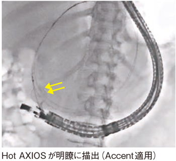 図7 症例4:仮性囊胞症例(Accent適用) 図7 症例4:仮性囊胞症例(Accent適用)