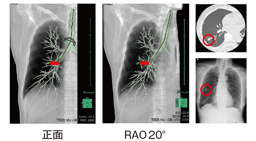 図3　バーチャルフルオログラフィを作成しCアーム角度を確認