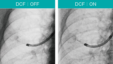 図6　DCF（デジタル補償フィルタ）適用例 肺野が白とびせず、病変・シースが見やすい。 Accent適用、スコープ：BF-P290、ガイドシース：SG-400C（オリンパス社製）