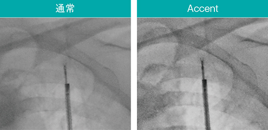 図8　Accentによる鉗子や関心領域の強調 スコープ：BF-MP290、生検鉗子：FB-433D（オリンパス社製）