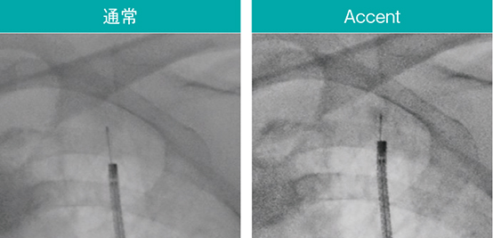 図9　Accentによるブラシや関心領域の強調 スコープ：BF-MP290、細胞診ブラシ：BC-205D-2010（オリンパス社製）