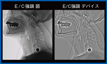 図6　嚥下造影検査（Accent適用）