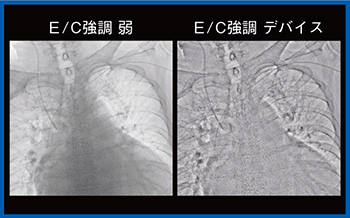 図5　PICC（Accent適用）
