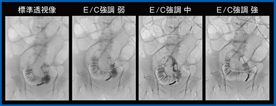 図7　経イレウス管小腸造影（Accent適用）
