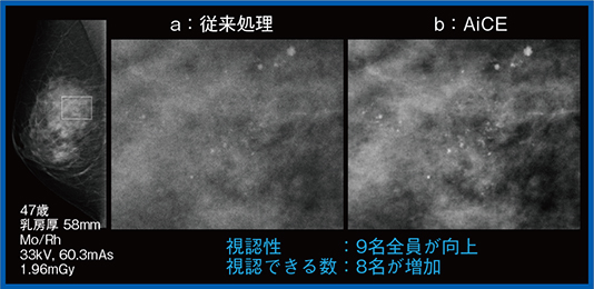 図4　症例1：密着撮影における石灰化の評価