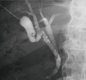 図4　症例1：B8が胆囊管に合流する破格 合流部に結石を認める。