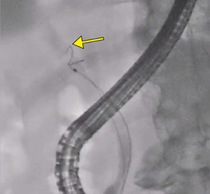 図5　症例1：B8が胆囊管に合流する破格 ラジフォーカス（“35←）で胆囊管をシーキング