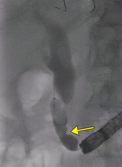 図7　症例3：バルーンでの乳頭拡張 ←のノッチが明瞭に視認できる。