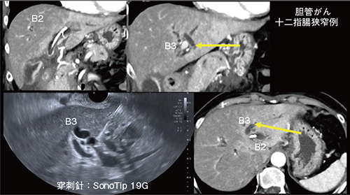 図3　左肝内胆管への穿刺（胆管がん・十二指腸狭窄例）