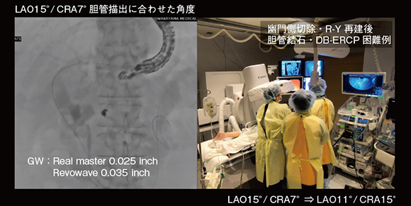 図4　Cアームによる胆管描出に合わせた角度づけ（幽門側切除・R-Y再建後胆管結石・DB-ERCP困難例）