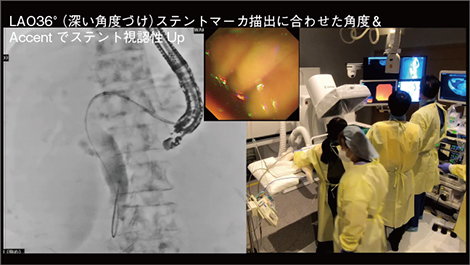 図7　症例2：肺がん・十二指腸再発例