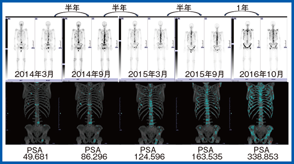 図6　症例5：前立腺がん骨転移の増悪症例