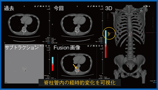 図4　TSB Vertebral Subtractionによる脊柱管内の経時的変化の可視化