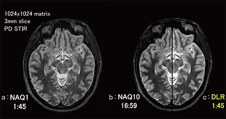 図5　PD STIR画像における10回加算（NAQ10）とDLRの比較