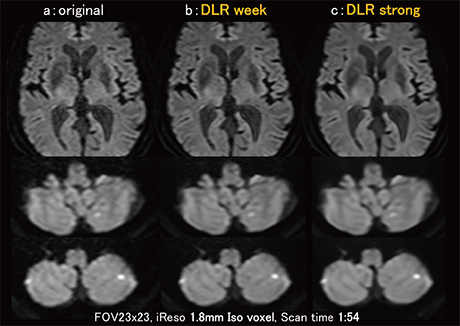 図6　1.8mm iso voxel拡散強調画像におけるDLRの効果
