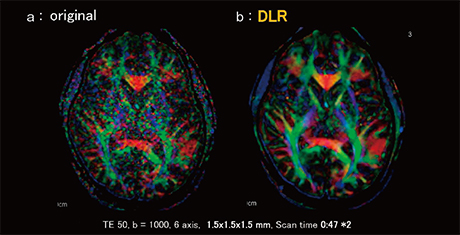 図8　1.5mm iso voxel拡散テンソル画像におけるDLRの効果