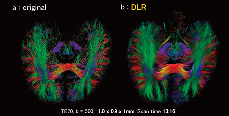 図9　高分解能拡散テンソルトラクトグラフィにおけるDLRの効果