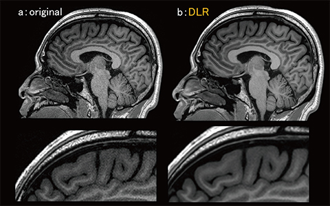図11　0.8mm iso voxel MPRAGE画像におけるDLRによるノイズ低減