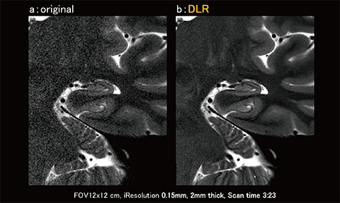 図12　高分解能T2強調画像におけるDLRによるノイズ低減