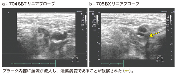 図2　症例1：脳梗塞精査にてPLI-705BXで病変が明瞭になった症例