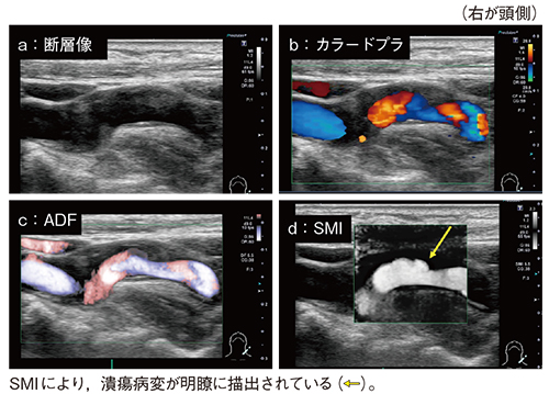 図5　SMIによる頸動脈潰瘍病変の描出能の向上