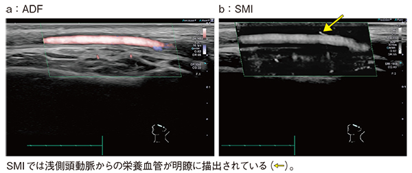 図7　症例3：24MHzリニアプローブとSMIによる巨細胞性動脈炎の描出