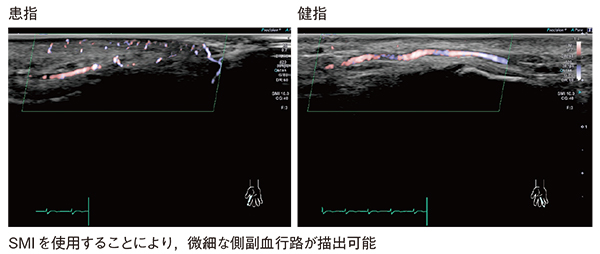 図8　症例4：‌24MHzリニアプローブとSMIによるレイノー現象の評価