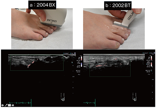 図9　22MHzホッケー型リニアプローブ（b）による足趾の血流評価