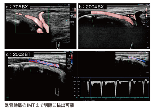 図10　プローブによる足背動脈の描出能の違い