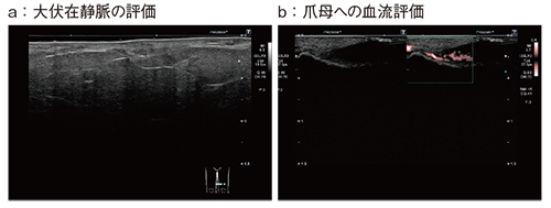 図12　33MHz超・超高周波リニアプローブによる大伏在静脈と爪母の評価