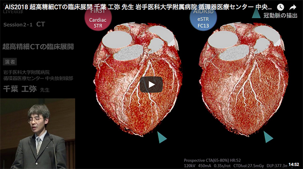 超高精細CTの臨床展開 千葉　工弥（岩手医科大学附属病院循環器医療センター 中央放射線部）