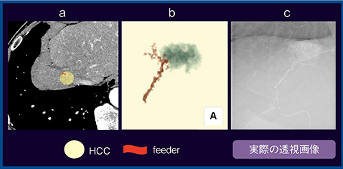 図7　症例6：S8，30mm大HCC（60歳代，男性） a：Aquilion Precision　b：VR画像　c：透視画像