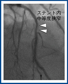 図5　図4の症例のCAG