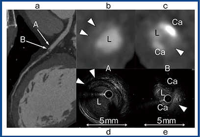 図6　Aquilion Precisionでのプラーク評価 a〜c：Aquilion Precision　d，e：IVUS
