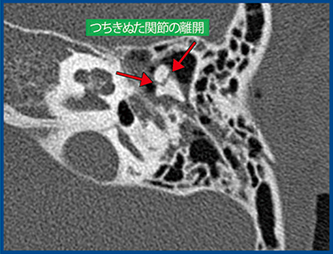 図2　Aquilion Precisionで明瞭に描出される耳小骨脱臼（0.25mm厚）