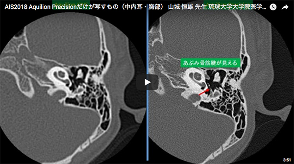 Aquilion Precisionだけが写すもの（中内耳・胸部） 山城　恒雄（琉球大学大学院医学研究科 放射線診断治療学講座）