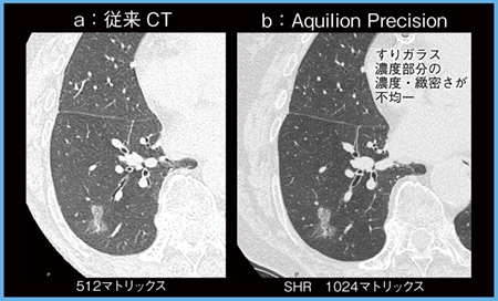 図5　症例5：乳頭型腺癌（拡大像）