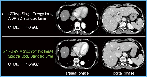 図2　ほぼ同線量で撮影した120keV画像と70keV Mono画像の比較