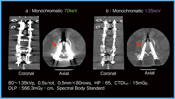 図4　症例2：135keV Mono画像による金属アーチファクト低減（腰椎後方椎体固定術後）