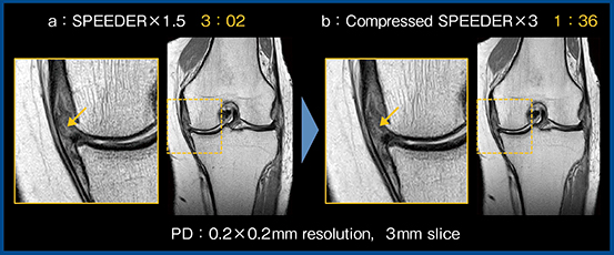 図3　PD強調画像におけるSPEEDER（a）とCompressed SPEEDER（b）の比較（内側半月板の逸脱・水平断裂）