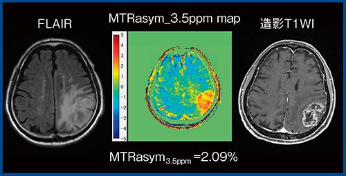 図2　FFE3DによるMTRasym_3.5ppm map（膠芽腫）