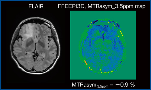 図5　Low grade glioma（WHO gradeⅡ）のMTRasym_3.5ppm map