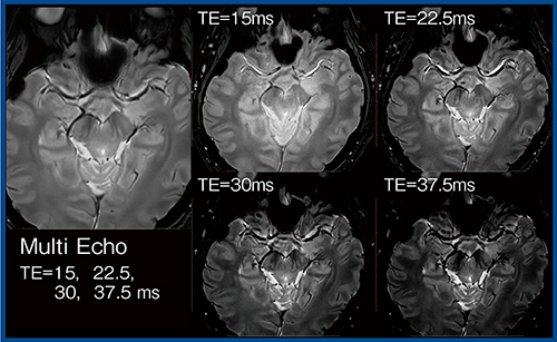 図5　マルチエコーT2＊強調画像によるnigrosome-1の可視化（正常例）