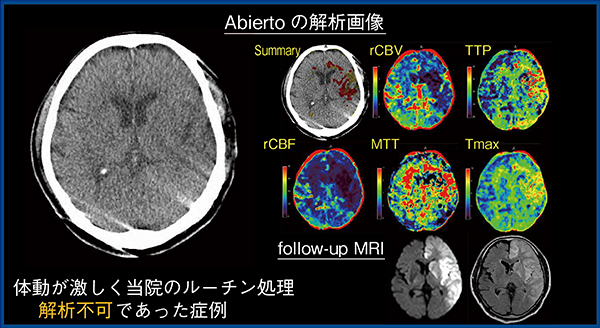 図4　Abierto RSSが有効だった症例 （70歳代，男性，左内頸動脈閉塞）