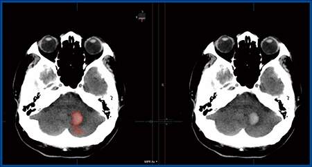 図2　Abierto RSSのHemorrhage analysis