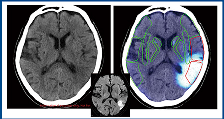 図3　Ischemia analysisのCT-ASPECTS自動計算1