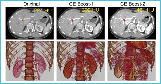 図1　CE Boostを利用した造影効果向上